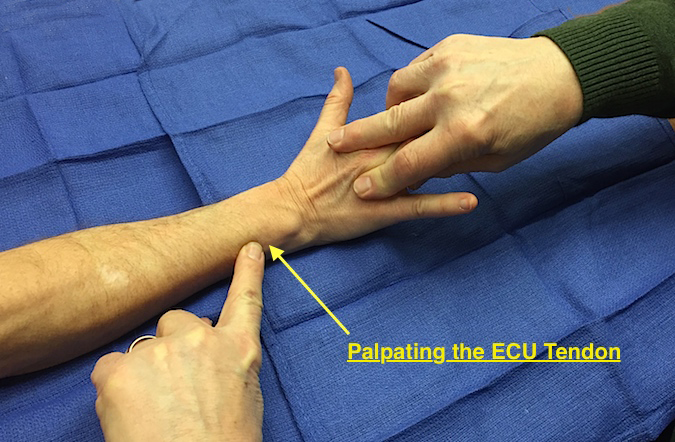 Ecu Tendinopathy